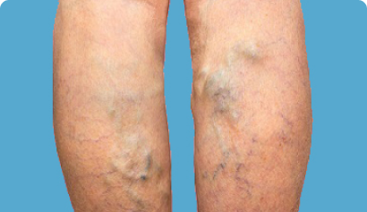 Do’s And Don’ts For Varicose Veins